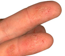 Eczema on Fingers - A natural eczema treatment that works