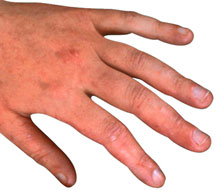 Symptoms And Causes Of Common Forms Of Occupational Dermatitis