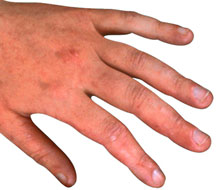 Irritant+contact+dermatitis+pictures