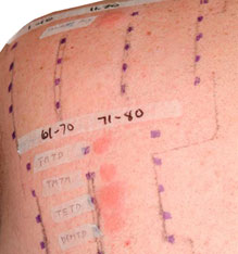 Positive patch test reactions